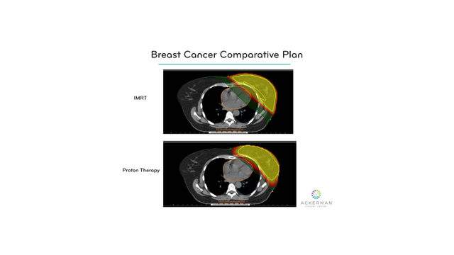 The Benefits Of Proton Therapy In The Treatment Of Breast Cancer