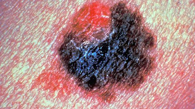 Can new melanoma therapy stop the spread?