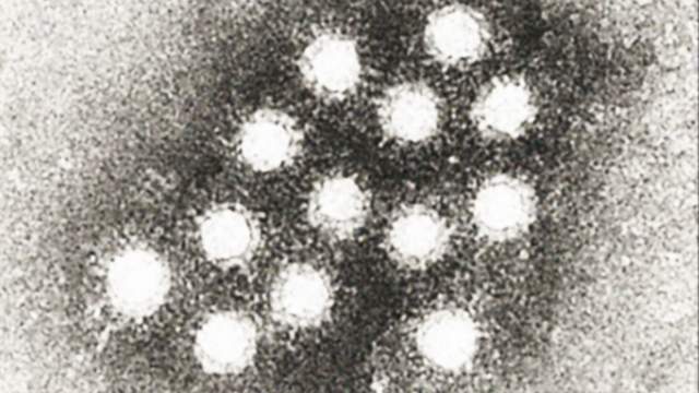 Florida adds 74 hepatitis A cases in June