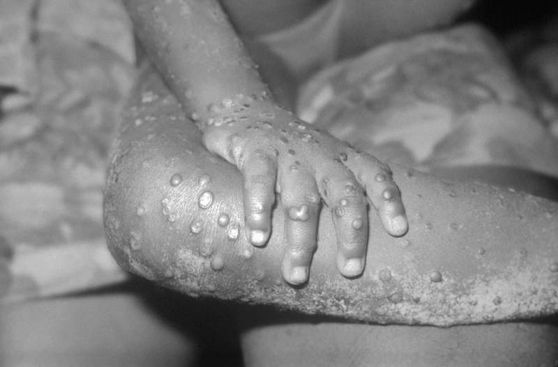 U.S. sees first case of rare monkeypox disease since 2003
