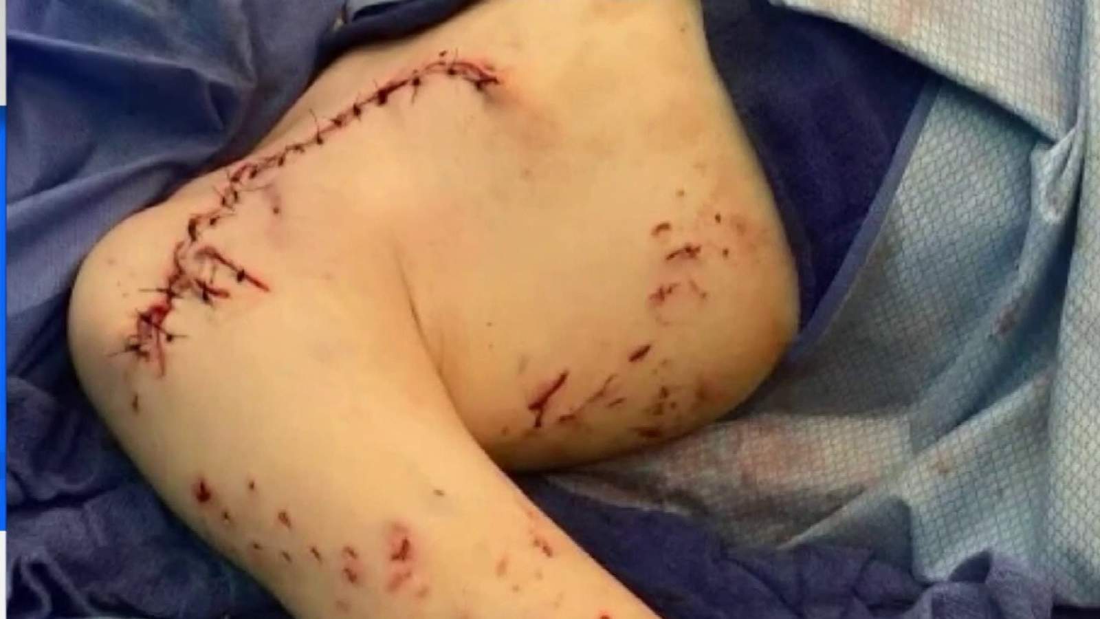 9-year-old boy recovering after bite at Florida beach