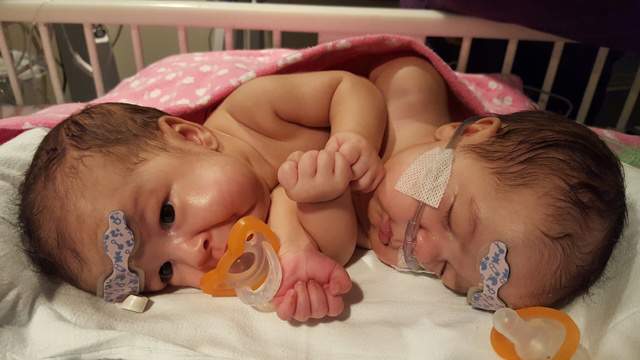 Conjoined Twins Separated At Uf Health